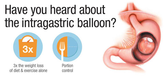 IntragastricBalloonGraphic